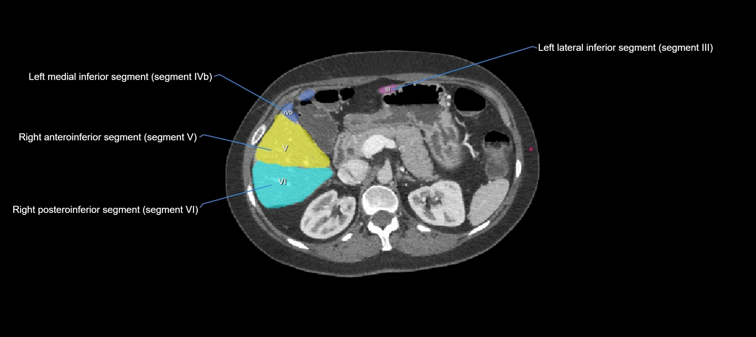 CT liver segments axial cross sectional anatomy labelled image-00034.webp